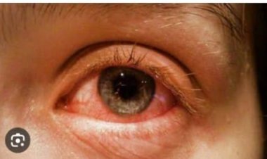 उदयपुरवाटी में आई फ्लू को लेकर आमजन सतर्कता बरतें -डॉक्टर अनिमेष गुप्ता