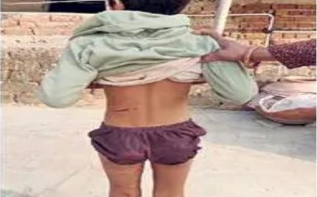 खैरथल में श्वानों का आतंक:  श्वानों के हमले में बालिका घायल, सिर व पैरों में जख्म