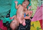 महिला ने दिया दो सिर और चार हाथ वाली बच्ची को जन्म, डॉक्टर भी रह गए हैरान