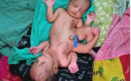 महिला ने दिया दो सिर और चार हाथ वाली बच्ची को जन्म, डॉक्टर भी रह गए हैरान