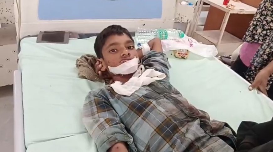 आतिशबाजी करते समय बम फटा भाई की उंगली हुई अलग, बहिन झुलसी