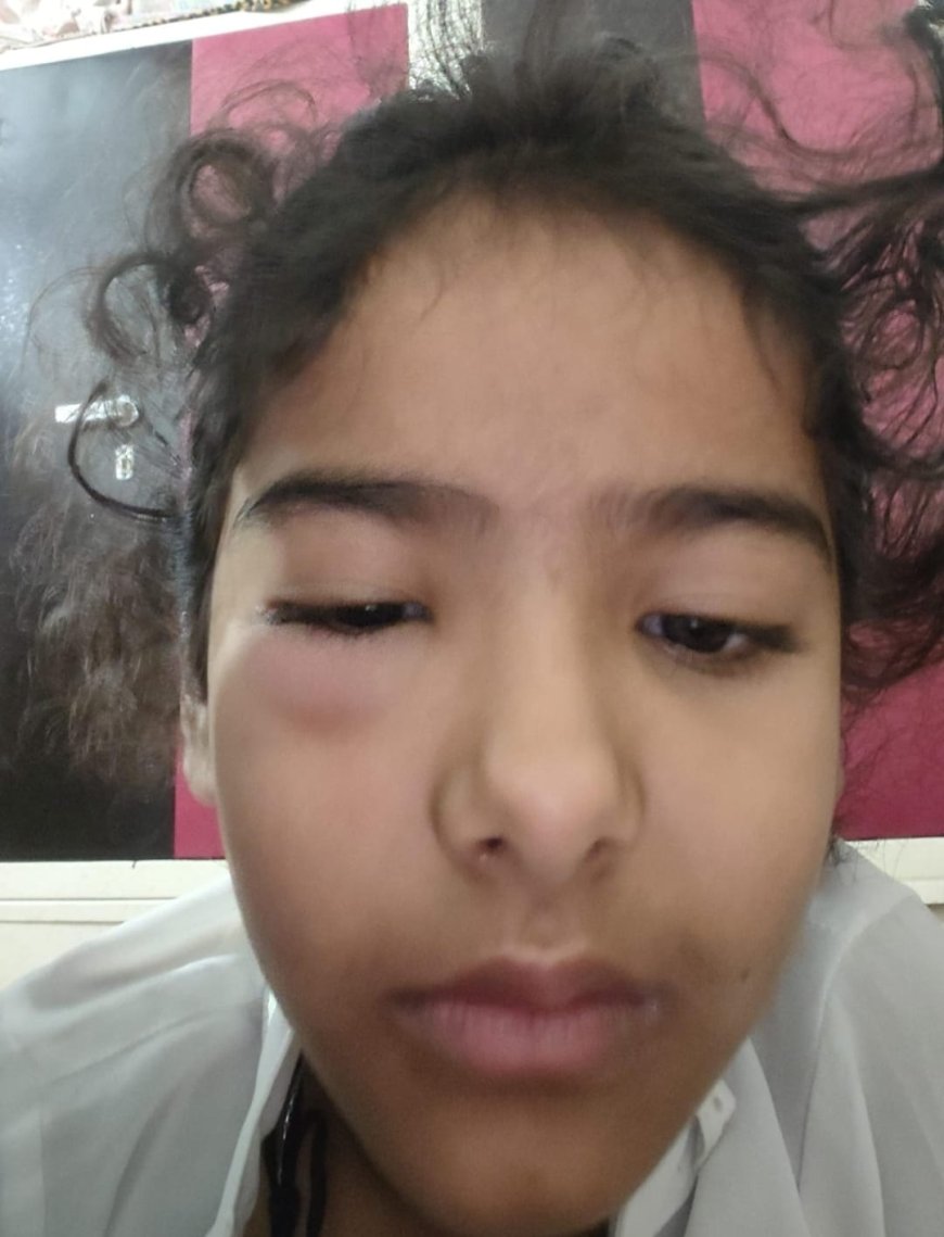 खैरथल में शिक्षा मंदिर पर सवालः शिक्षक की पिटाई से प्रेप की छात्रा की आंख में लगी चोट