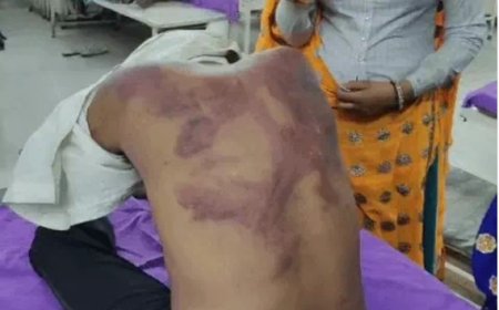 पुरानी रंजिश को लेकर दो पक्षों में खूनी संघर्ष; लाठी-डंडों से हमले में दो युवक गंभीर घायल, दोनों की पीठ पर मारपीट के निशान