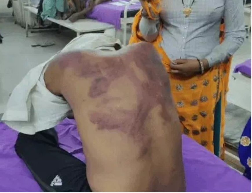 पुरानी रंजिश को लेकर दो पक्षों में खूनी संघर्ष; लाठी-डंडों से हमले में दो युवक गंभीर घायल, दोनों की पीठ पर मारपीट के निशान