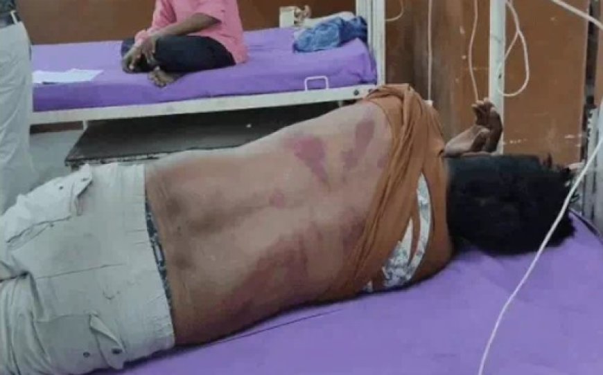 पुरानी रंजिश को लेकर दो पक्षों में खूनी संघर्ष; लाठी-डंडों से हमले में दो युवक गंभीर घायल, दोनों की पीठ पर मारपीट के निशान