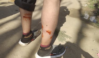 नांगल सतोकडा में बिजली की रीडिंग कर रहे लाइनमैन को कुत्तों ने काटा