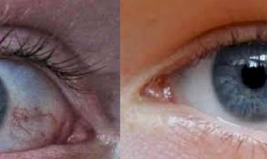 मोतियाबिन्द के बाद कालापानी (ग्लोकोमा) अंधता का दूसरा प्रमुख कारण है- डॉ. रिंकू मेहता