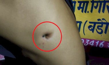 आपसी विवाद में युवक की पसलियों में सरिए घुसा, अंदर ही तोड़ दिया अलवर रेफर